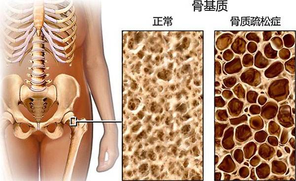 骨質(zhì)健康問(wèn)題.jpg