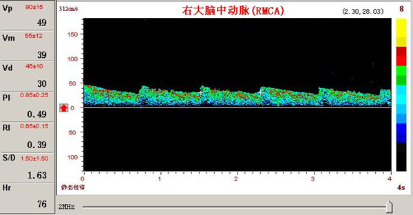 超聲經(jīng)顱多普勒腦動脈瘤頻譜圖.jpg