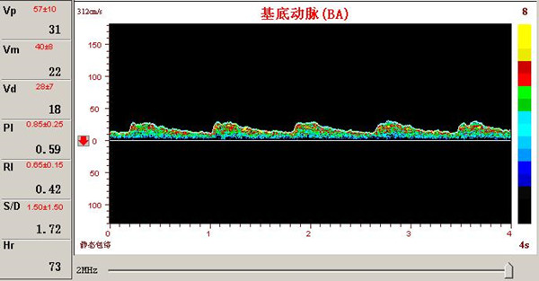 超聲經(jīng)顱多普勒基底動脈供血不足頻譜圖.jpg