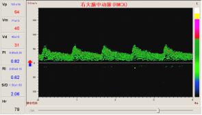 TCD檢測腦供血不足的頻譜圖像.jpg