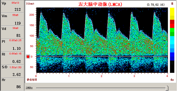 TCD對(duì)腦血管狹窄的臨床