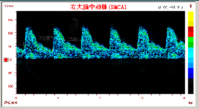 腦動脈硬化的TCD表現(xiàn)和常見疾病