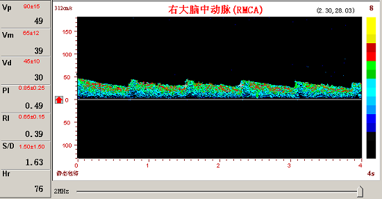 KJ系列超聲經(jīng)顱多普勒腦動(dòng)脈瘤頻譜圖