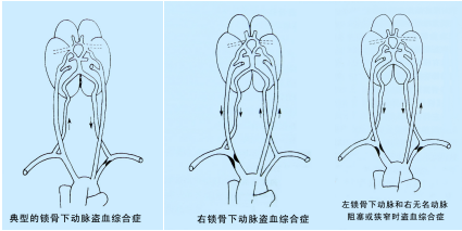 鎖骨下動(dòng)脈盜血綜合征超聲TCD表現(xiàn)